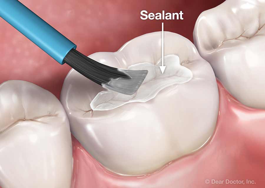 Dental Sealants.