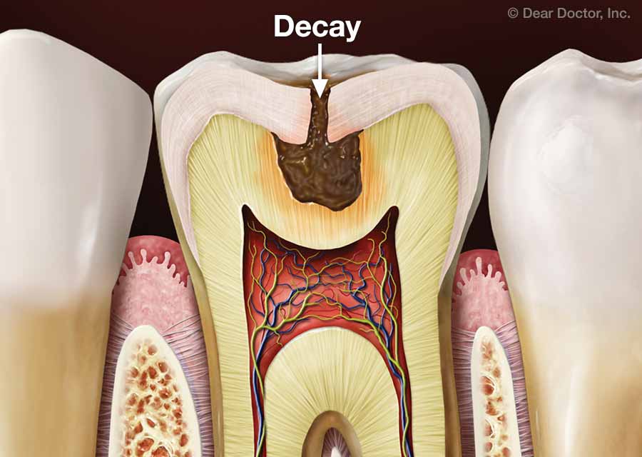 Tooth Decay.