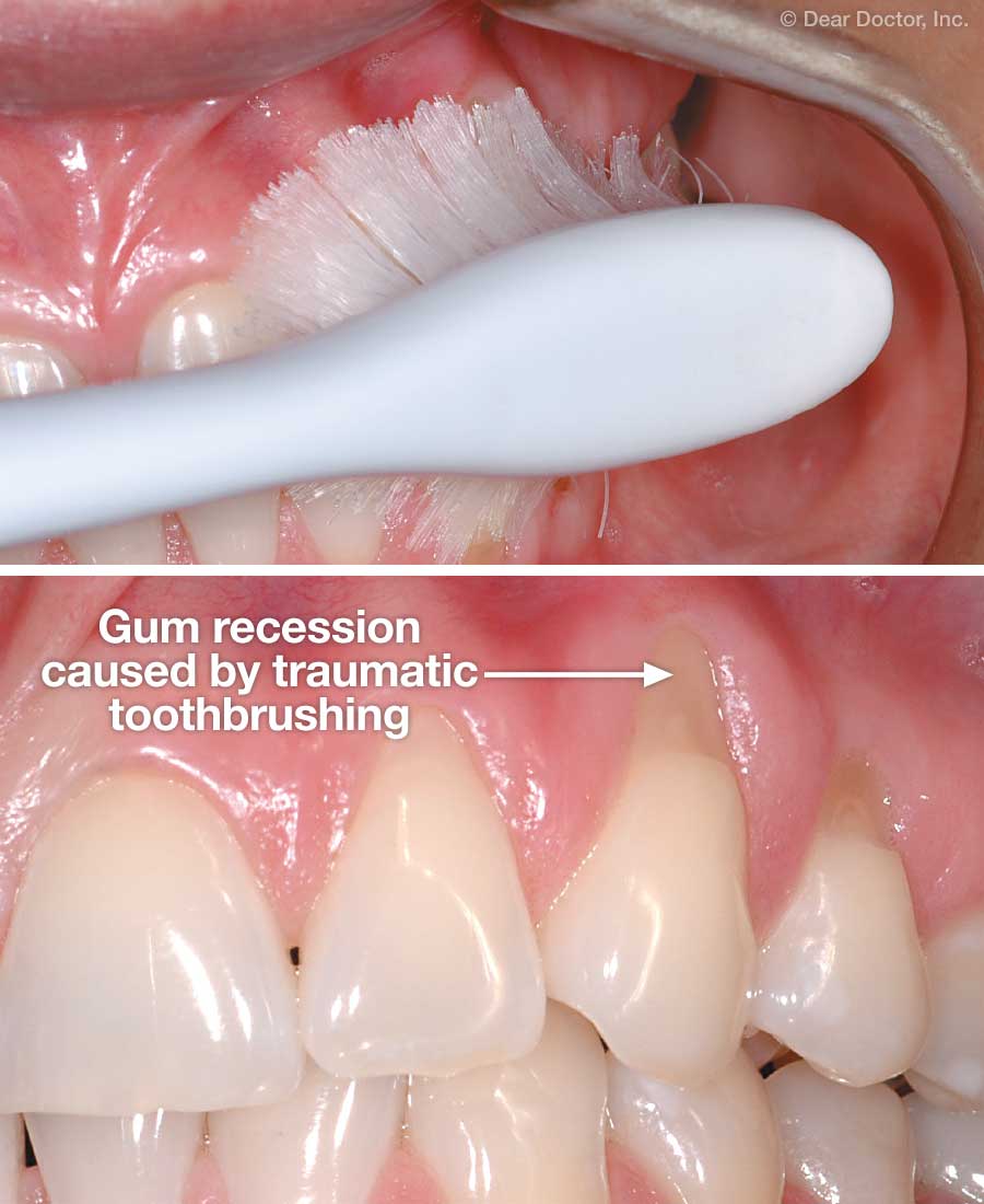 Gum Recession - Abrasion.
