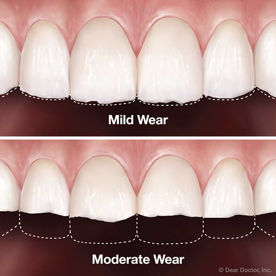 teeth loss of enamel