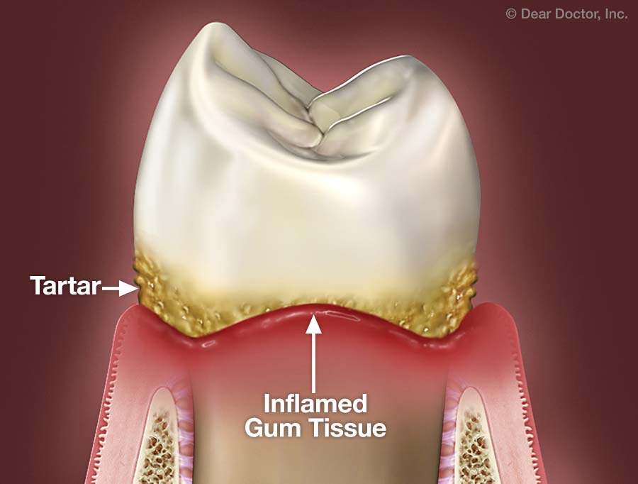 Gum disease.