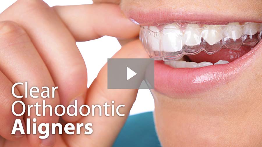 Clear Orthodontic Aligners video