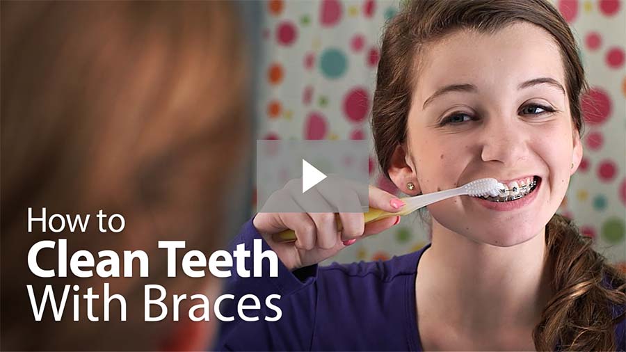 How to Clean Teeth With Braces video