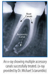 Accessory Root Canal x-ray