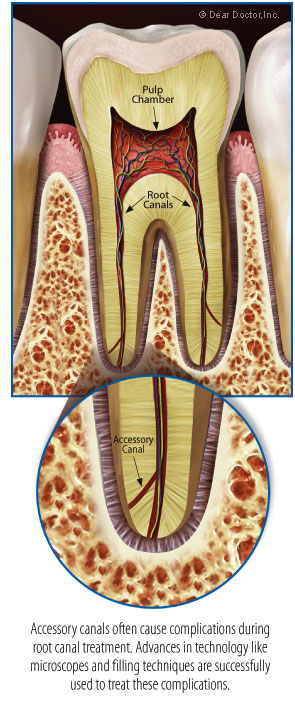 Accessory Root Canal