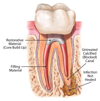 http://www.deardoctor.com/img/aae/root-canal-retreatment.jpg