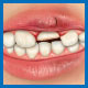 Nerve Damage to teeth