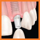 Implants vs. Bridgework