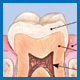 Root Canal Treatment