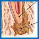 Root Canal Retreatment