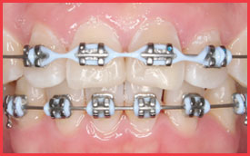 traditional braces