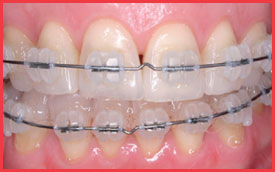 clear braces