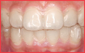 Invisalign Aligners
