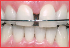 Orthodontic Appliance