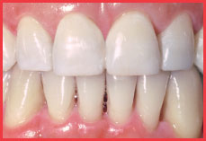 Orthodontic Result
