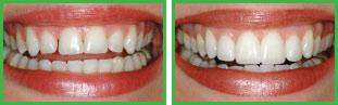 Porcelain Veneers Before and After