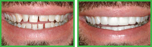 Porcelain Veneers Before and After