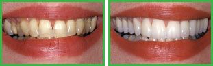 Porcelain Veneers Before and After