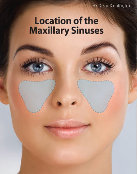 Location of the Maxillary Sinuses