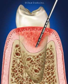 Periodontal Flap Surgery