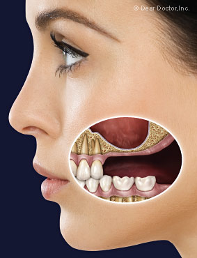 Sinus Surgery