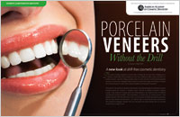 No-prep Procelain Veneers Okemos, MI - Dear Doctor Magazine