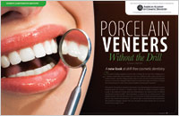 Article on Porcelain Veneers