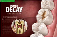 Dental Education East Aurora - Tooth Decay Dear Doctor Magazine