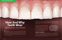 Tooth Wear - Dear Doctor Magazine