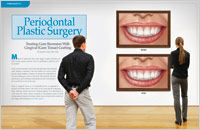 Periodontal Plastic Surgery - Gum Grafting, Westlake OH