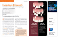 Implants vs Bridgework - Dear Doctor Magazine