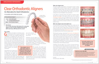 Invisalign Clear Orthodontic Aligners - Dear Doctor Magazine