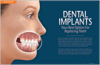 Dental implants - dear doctor magazine