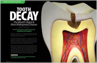 Tooth Decay - Preventative Dentistry Erie, PA