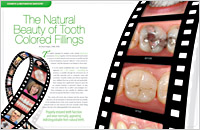 Dental Education East Aurora - Tooth Colored Fillings Dear Doctor Magazine