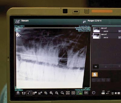 X-ray of Rutgers teeth after procedure.