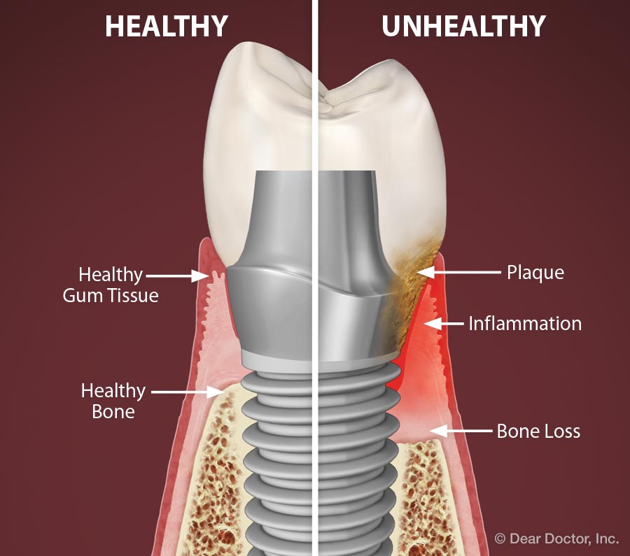 Peri-implantitis.