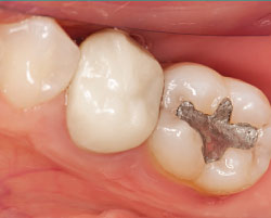 Mercury in dental amalgam.