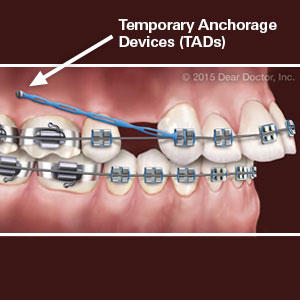 AnchorsMakealltheDifferenceinSuccessfulOrthodonticTreatment