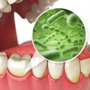 TheSecrettoPreventingGumDisease-ControlBacterialPlaque