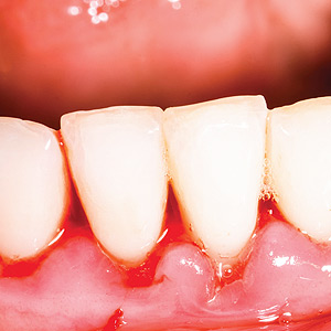 bleeding gums.