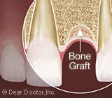 Bone Grafting can put Implants Back onYour Options List