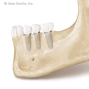 DentalImplantsHelpMaintainBoneHealth