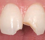 chipped-tooth3.jpg