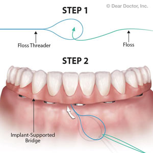 StopPlaqueBuildupAroundYourImplant-SupportedBridgeWithFlossing