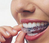 Clear Aligners.