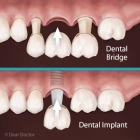 Could a Dental Bridge Be a Better Choice Than Implants?