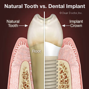 dental implants.
