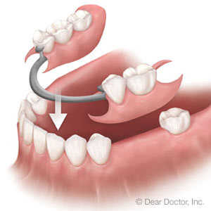 Partial Dentures