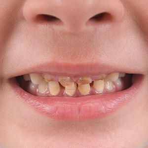 First Tooth Canine April 2018 Babies Forums What To Expect